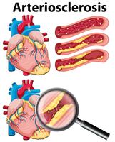 A Heart with Arteriosclerosis on White Background vector