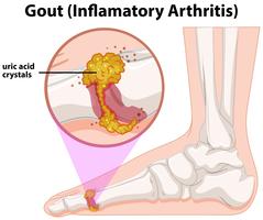 A Medical Human Anatomy Gout vector