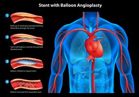 Stent with balloon angioplasty vector