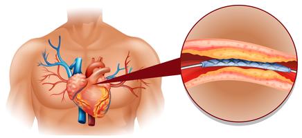 Diagrama del corazón humano con tubo de globo vector