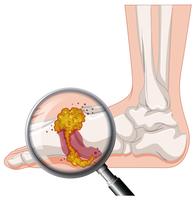 Gout In Human Foot vector