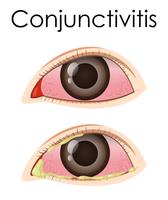 Diagram showing conjunctivitis in human vector