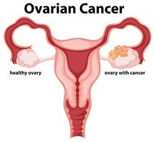 Mujer concepto de cáncer de ovario dibujo vector
