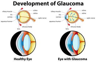 Diagrama que muestra el desarrollo de glaucoma vector