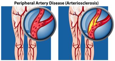 Una comparación de la enfermedad arterial periférica vector