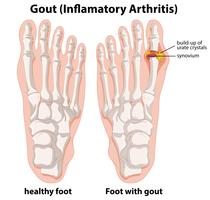 Diagram explanation of Gout in human foot