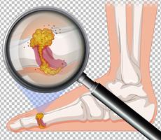 close up of infection on foot vector