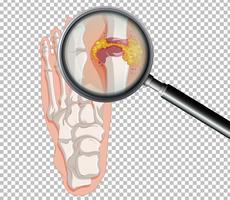 A Human Gout on Transparent Background vector