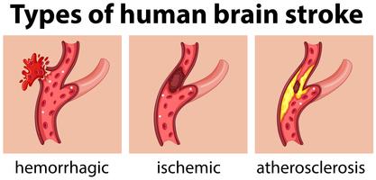 Types of human brain stroke vector
