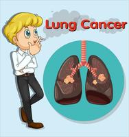 Hombre fumando y cáncer de pulmón. vector