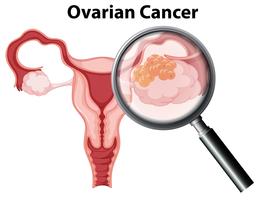 Cáncer de ovario en el fondo blanco vector