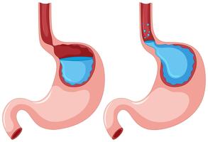 Diagrama de la enfermedad por reflujo gastroesofágico vector