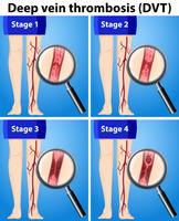 Cuatro etapas de la trombosis venosa profunda