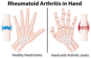 Diagrama que muestra la artritis reumatoide en la mano. vector