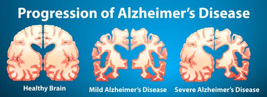 Progresión de la enfermedad de Alzheimer sobre fondo azul vector