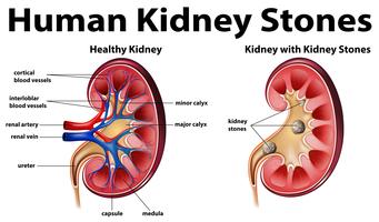Human anatomy diagram with kidney stones vector