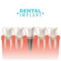 Dental Implant Model Side View Poster 