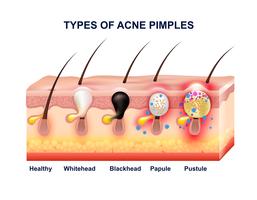 Composición de la anatomía del acné de la piel