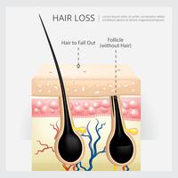 Hair Loss Structure Vector Illustration