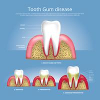 Dientes humanos etapas de la enfermedad de las encías ilustración vectorial vector