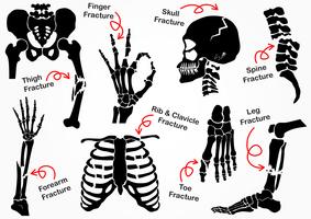 Set Bone Fracture Icon ( Pelvic , Hip , Thigh ( femur ) , Hand , Wrist , Finger , Skull , Face , Vertebra , Arm , Elbow , Thorax , Foot , Heel , Leg ) black & white design ( health care concept ) vector