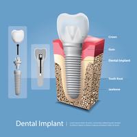 Human teeth and Dental implant Vector Illustration