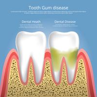 Human teeth Stages of Gum Disease Vector Illustration