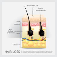 Ingrown Hair Structure Vector Illustration