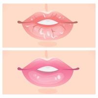 Flaky lips and beautiful lips vector