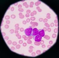 antecedentes de ciencias médicas que muestran células blásticas (aml) foto