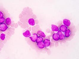 antecedentes de ciencias médicas que muestran células blásticas (aml) foto