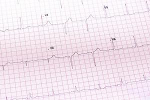 Electrocardiogram close-up photo