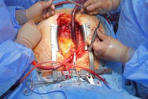 equipo de cirugía. trabajando con la aorta. foto