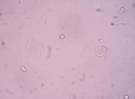 bladder epithelial cells in urine. photo