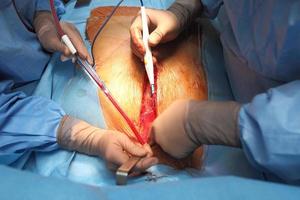 cirujanos de trabajo en equipo durante la cirugía a corazón abierto foto