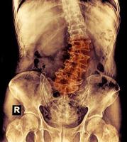 "Scoliosis" film x-ray lumbar spine AP