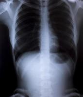 Imagen de rayos X del tórax humano para un diagnóstico médico