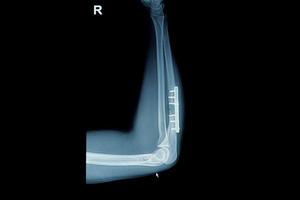 radiografía de fractura de muñeca por rayos X foto
