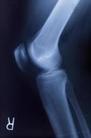 tobillo, pies y rodilla dolor en las articulaciones radiografía humana resonancia magnética foto