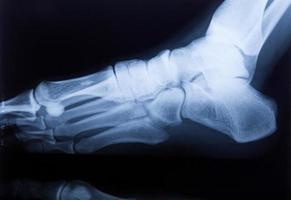 Ankle feet & knee joint pain Human X-ray MRI film photo
