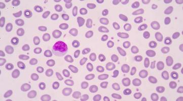 glóbulos rojos anómalos ovalocitos. foto