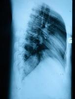 imagen de rayos x del pecho humano