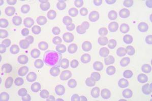 macrophage in urine sediment