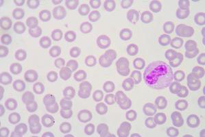 macrophage in urine sediment