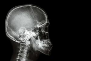 X-ray asian skull (Thai people) photo