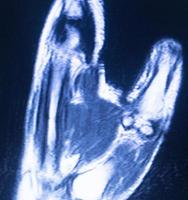 MRI magnetic resonance imaging hand carpal scan