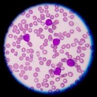 leucemia mielógena aguda (aml) .la mayoría de los subtipos de aml son distingui