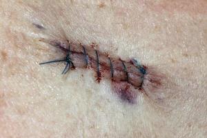 Stitches - Medical Procedure photo
