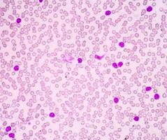 leucemia linfocítica crónica (cll) foto