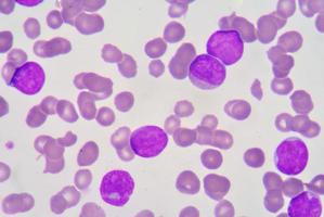 blast cell on blood smear